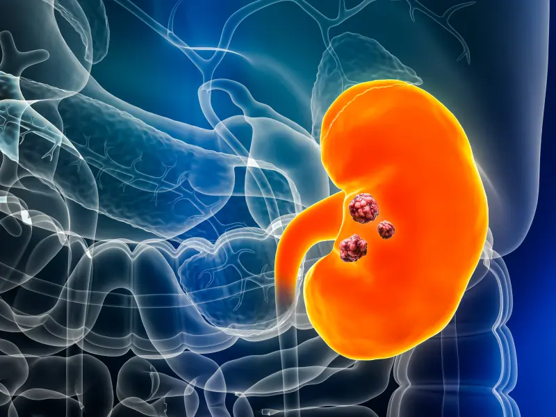 Predictors and prevention of renal flares: Pooled analysis of four phase III trials of belimumab